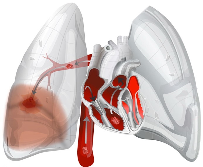 Arterele pulmonare si venele pulmonare